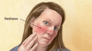 rosacea