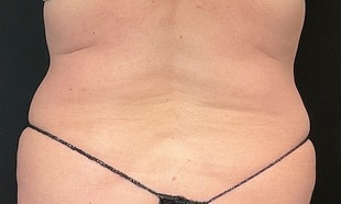 After Image: EvolveX for Flanks - back
