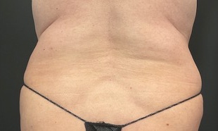 Before Image: EvolveX for Flanks - back