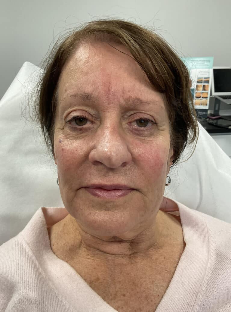 After Image: Derma PRP - front
