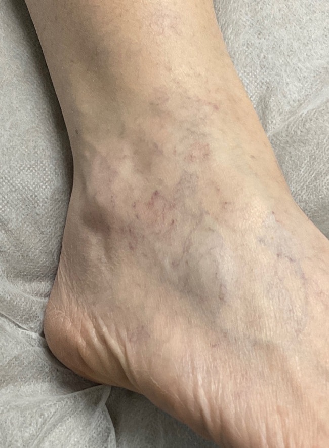 After Image: Leg Veins - front