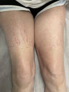 After Image: Leg Veins