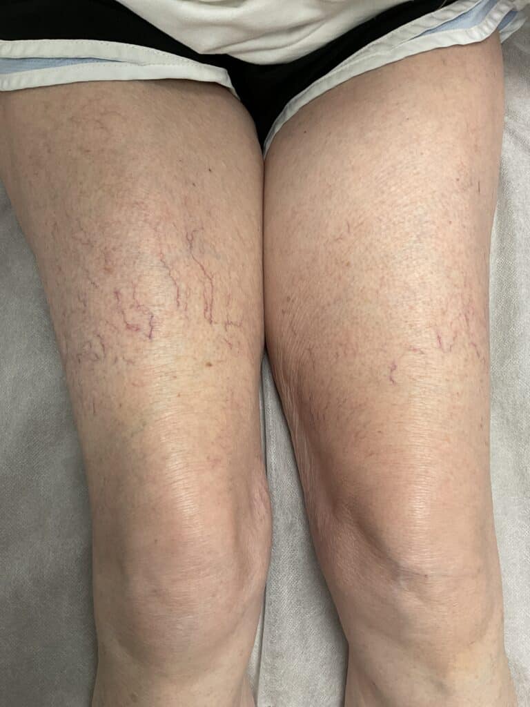 After Image: Leg Veins - front