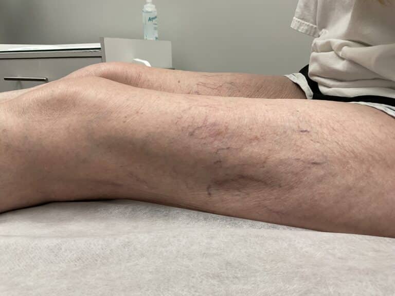 After Image: Leg Veins - front