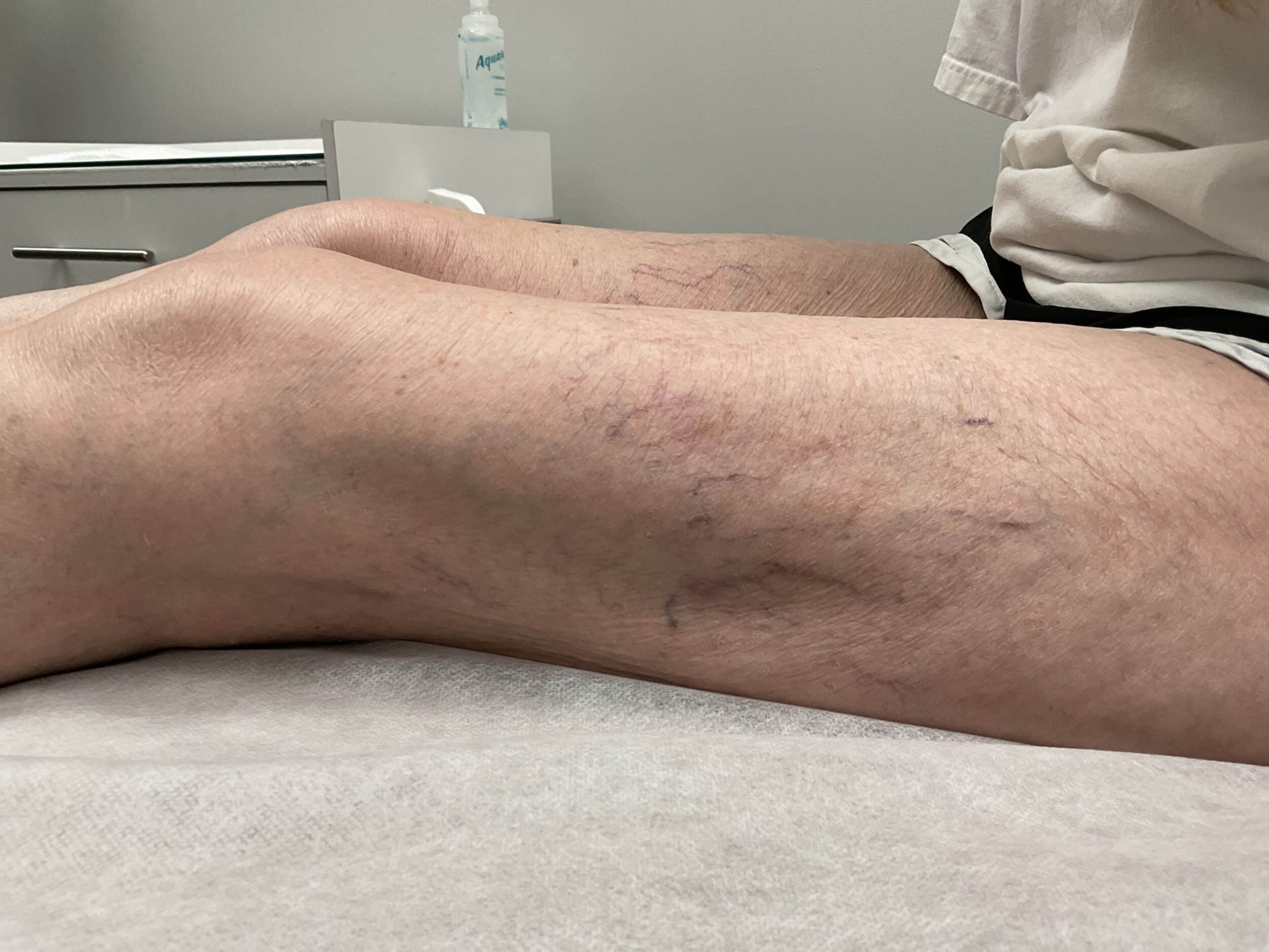 After Image: Leg Veins - front
