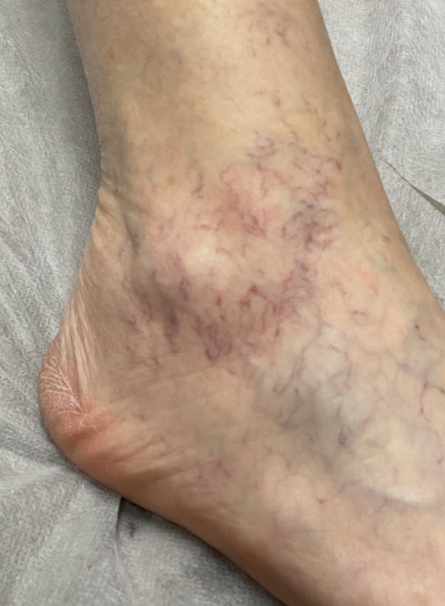 Before Image: Leg Veins - front