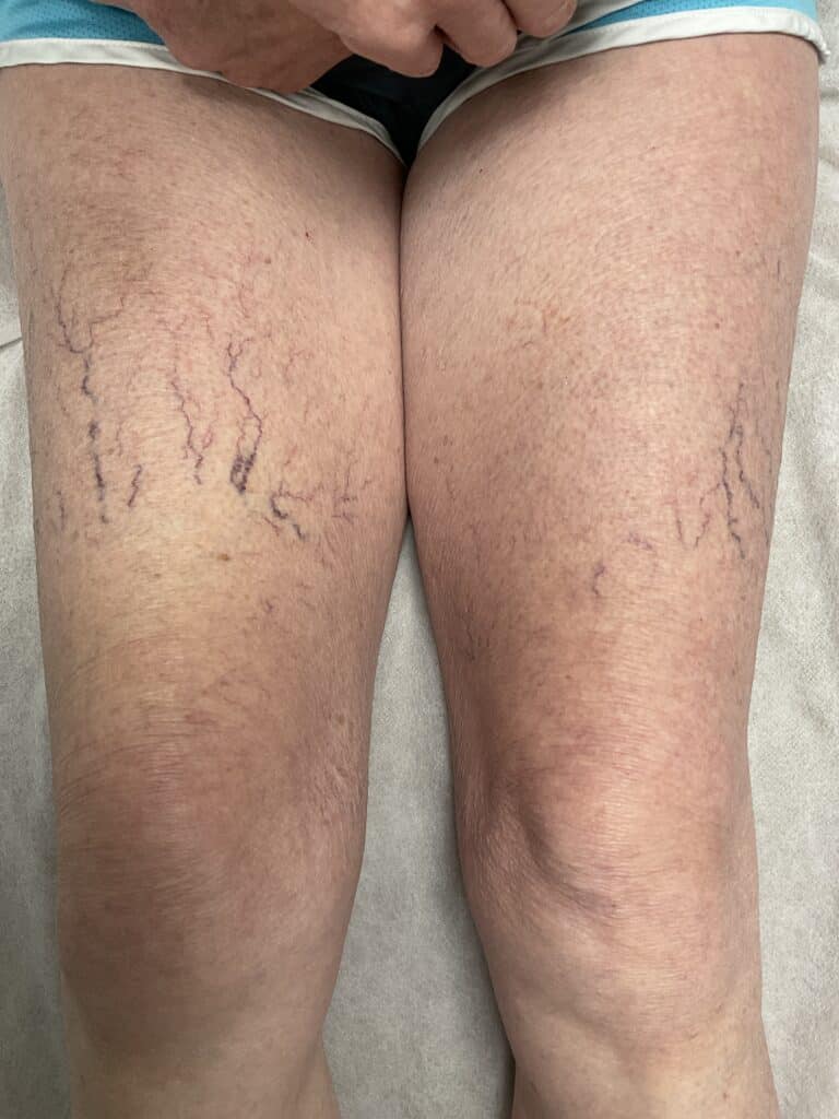 Before Image: Leg Veins - front