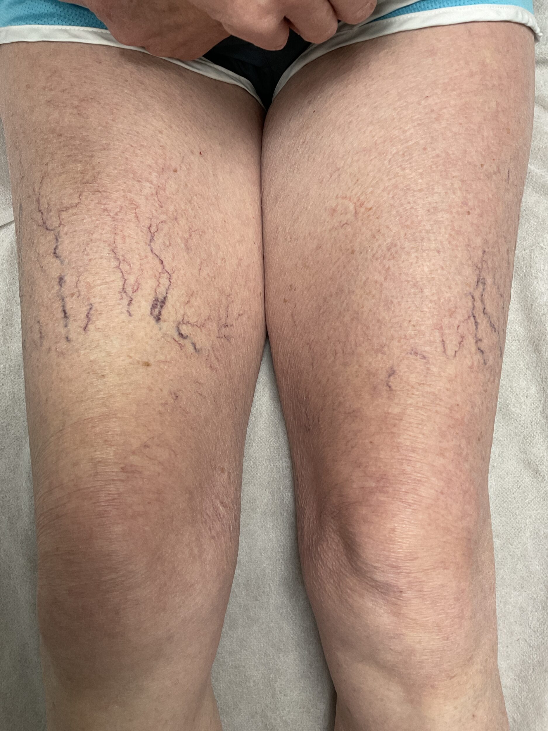 Before Image: Leg Veins - front