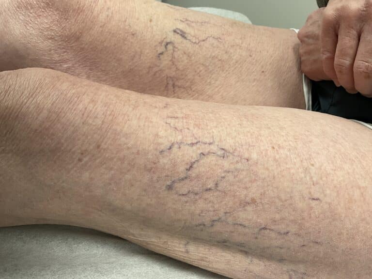 Before Image: Leg Veins - front