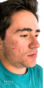 After Image: Microneedling Acne