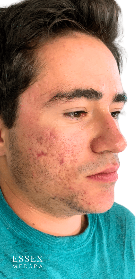 After Image: Microneedling Acne - right-front-oblique