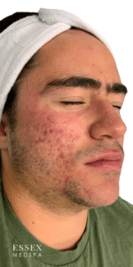 Before Image: Microneedling Acne
