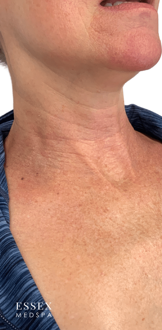 Before Image: Fractional CO2 - right-front-oblique