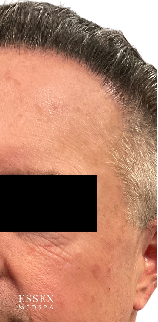 After Image: IPL - left-front-oblique