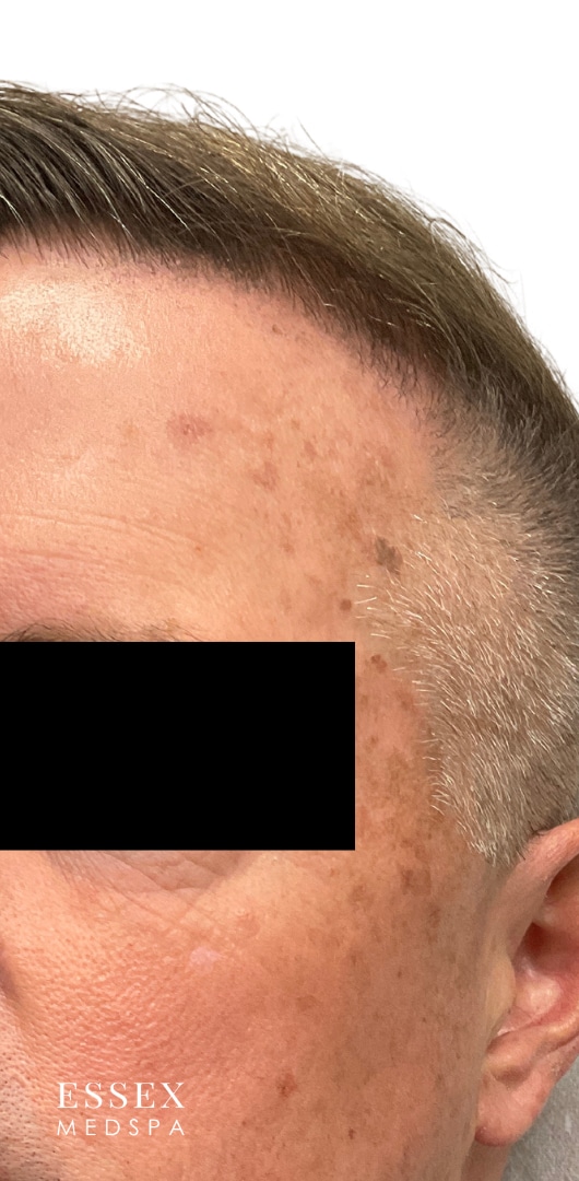 Before Image: IPL - left-front-oblique