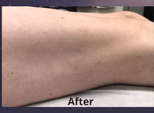 After Image: Leg Veins - right-side