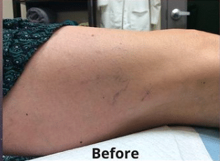 Before Image: Leg Veins - right-side