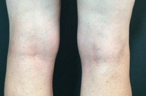 After Image: Leg Veins