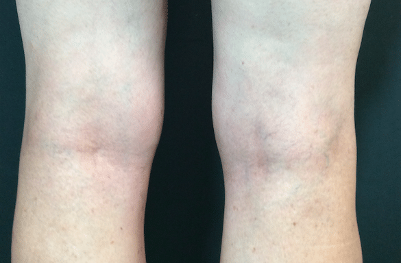 After Image: Leg Veins - back