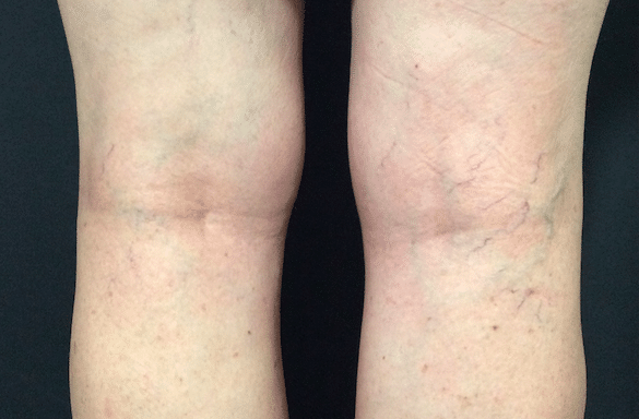 Before Image: Leg Veins - back