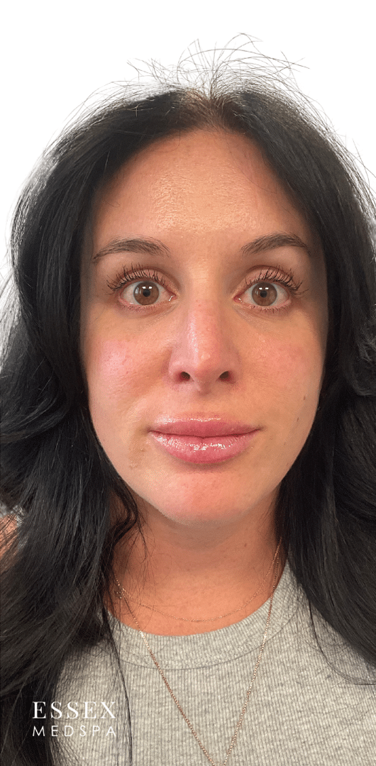 After Image: Lip Filler - front