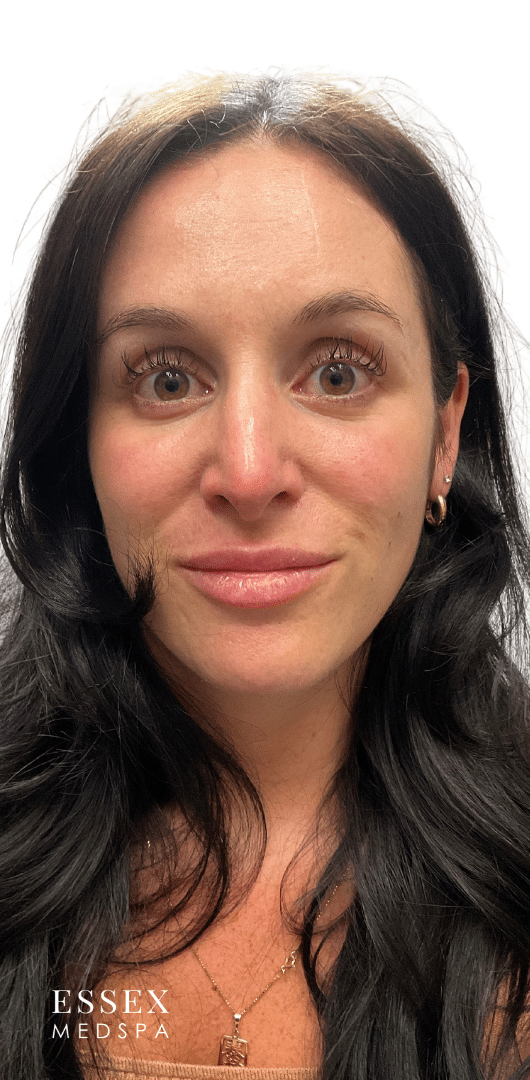 Before Image: Lip Filler - front