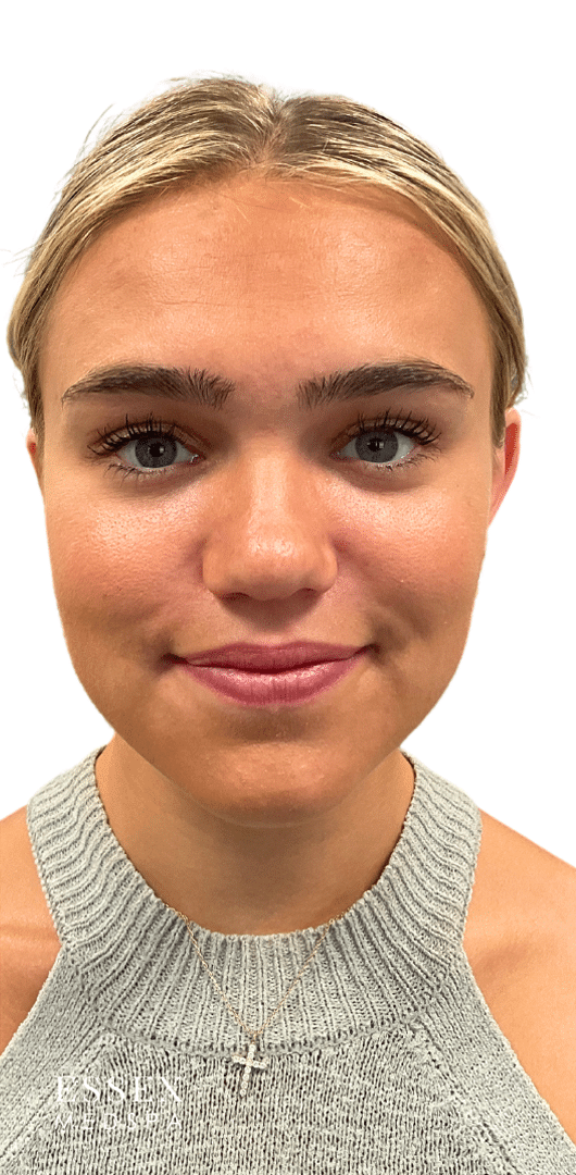 After Image: Lip Filler - front