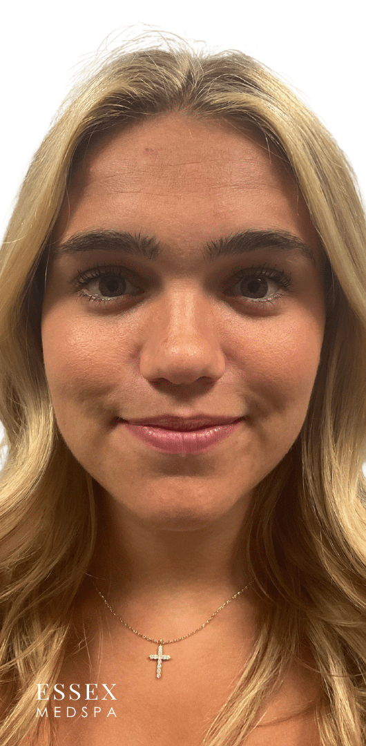 Before Image: Lip Filler - front