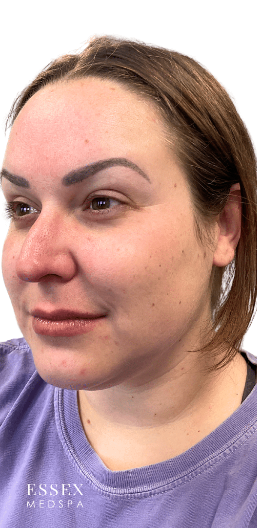 After Image: Neurotoxin – Masseters and Facial Slimming - left-front-oblique