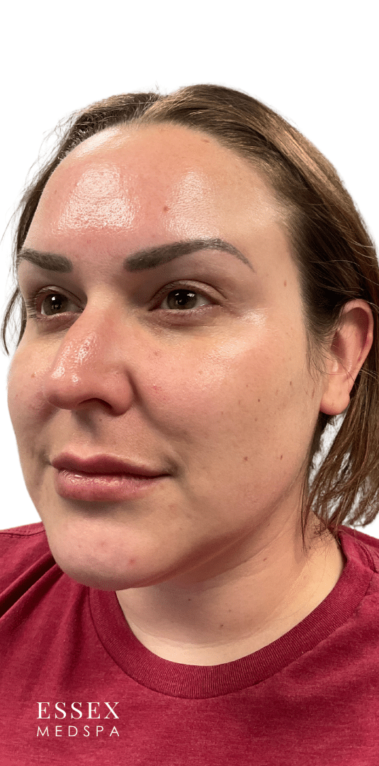 Before Image: Neurotoxin – Masseters and Facial Slimming - left-front-oblique