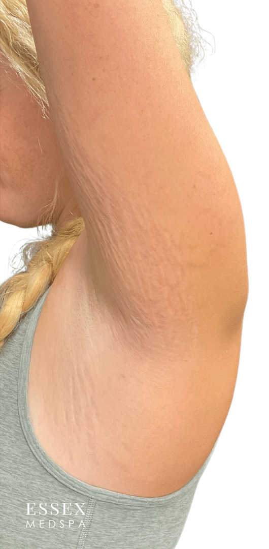 After Image: Morpheus8 for Stretch Marks - left-side