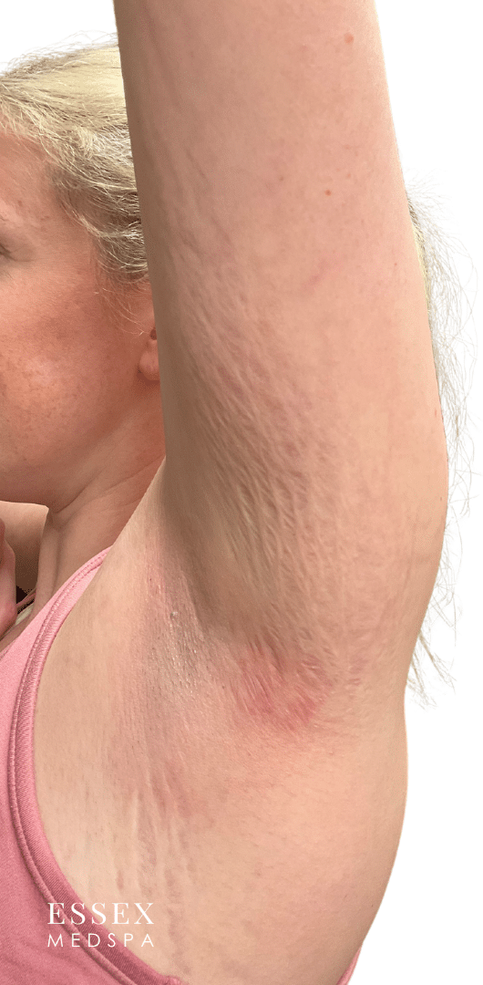 Before Image: Morpheus8 for Stretch Marks - left-side