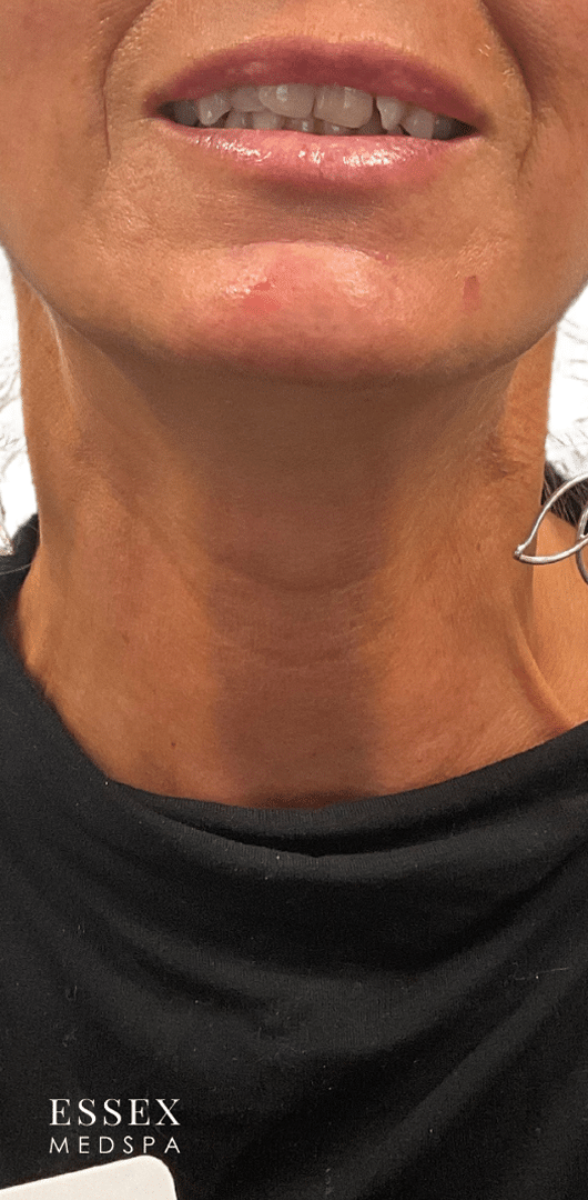After Image: Nefertiti Neck Lift - front