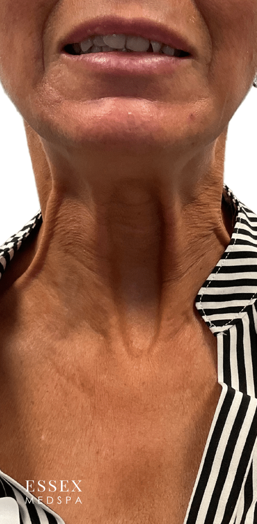 Before Image: Nefertiti Neck Lift - front
