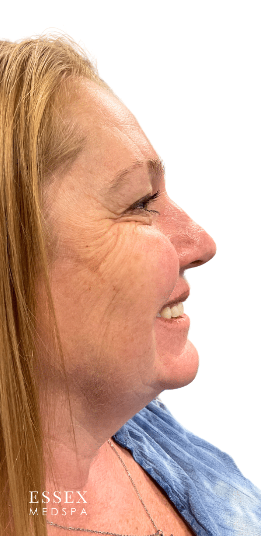 After Image: Neurotoxin for Crows Feet - right-side