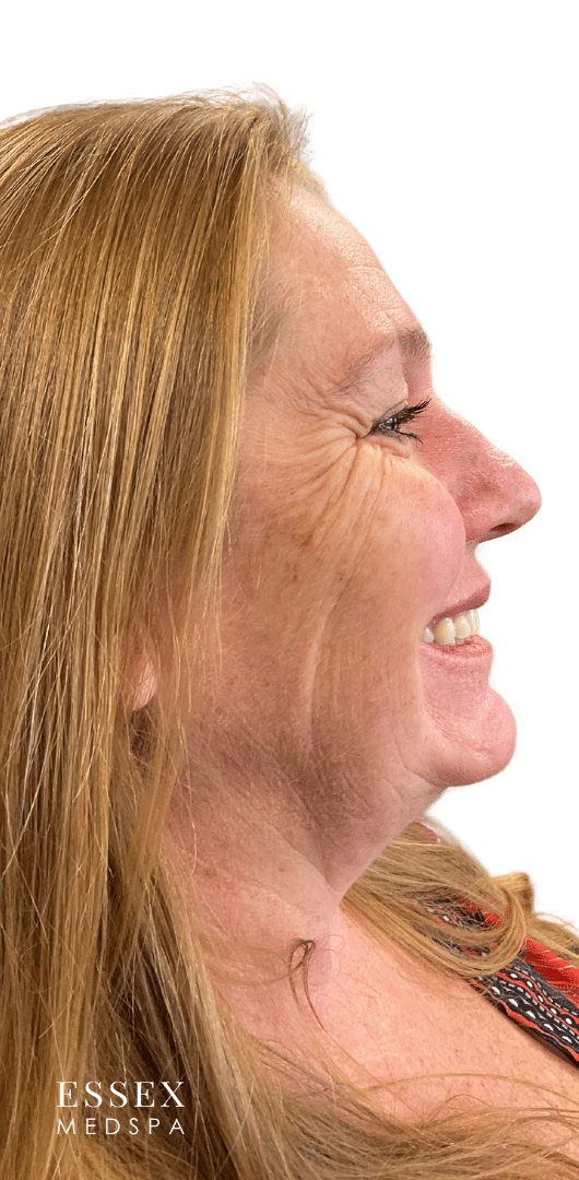 Before Image: Neurotoxin for Crows Feet - right-side