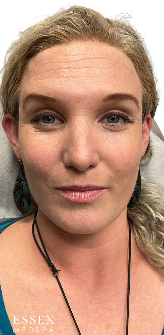 After Image: Neurotoxin – Forehead - front