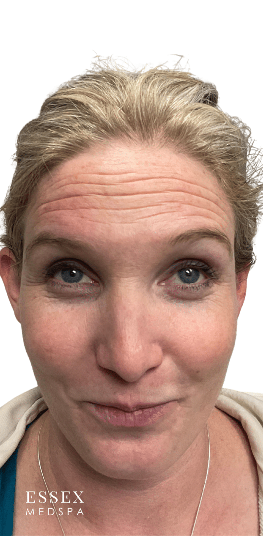 Before Image: Neurotoxin – Forehead - front