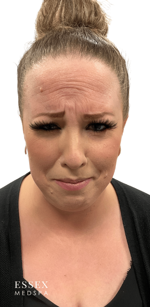 Before Image: Neurotoxin – Forehead and Glabella - front