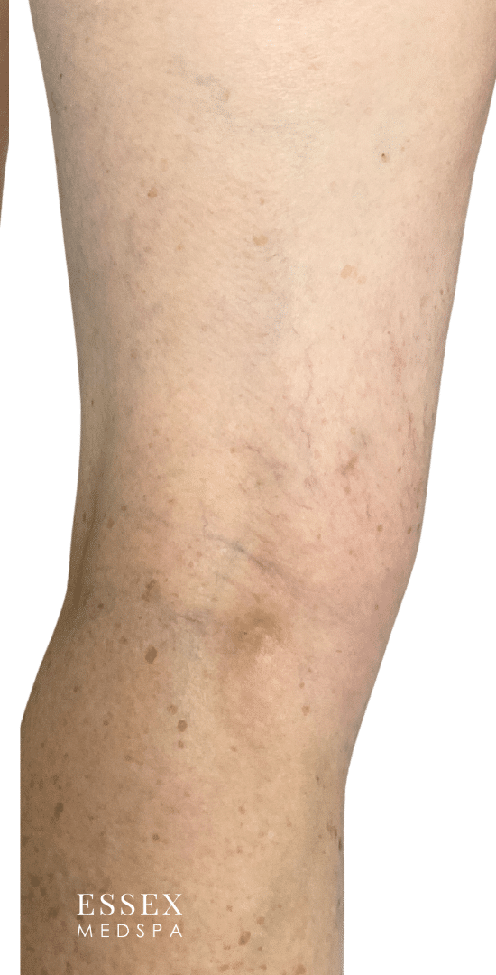 After Image: Sclerotherapy - back