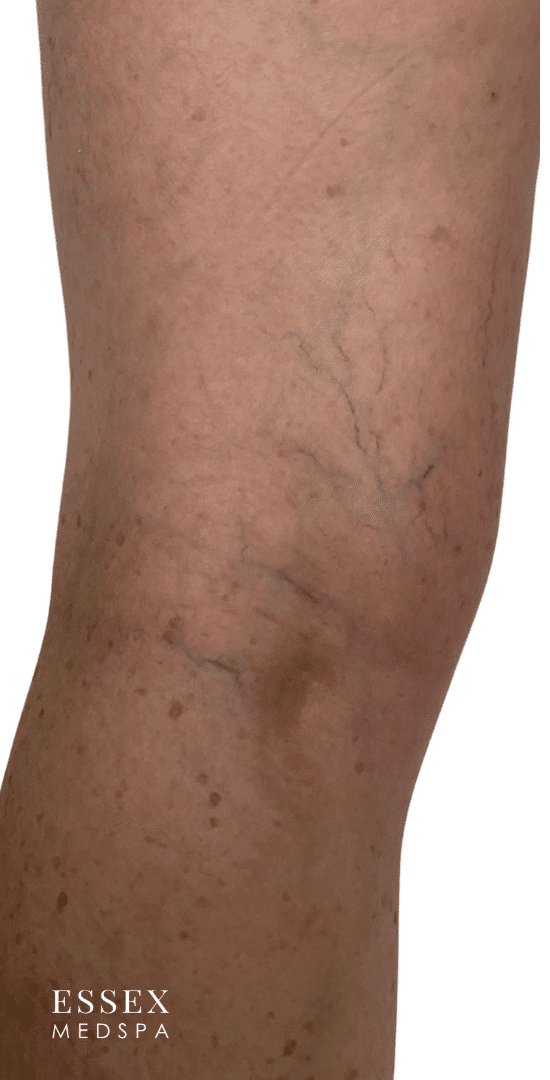 Before Image: Sclerotherapy - back