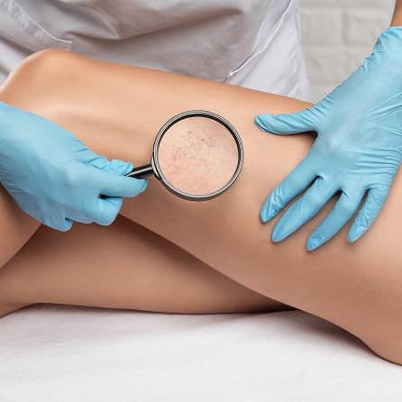 Sclerotherapy min