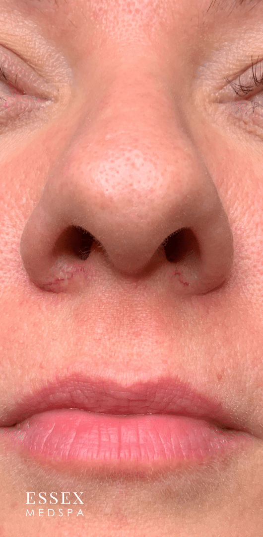 Before Image: Thermo-Lo - front