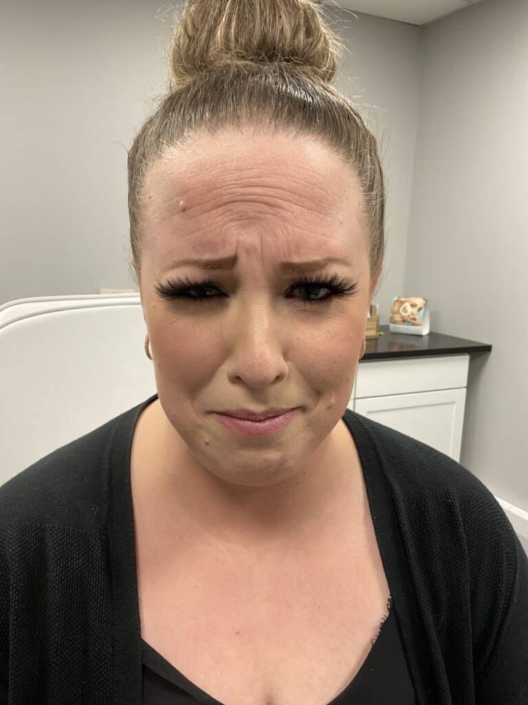 After Image: Neurotoxin – Forehead and Glabella - front