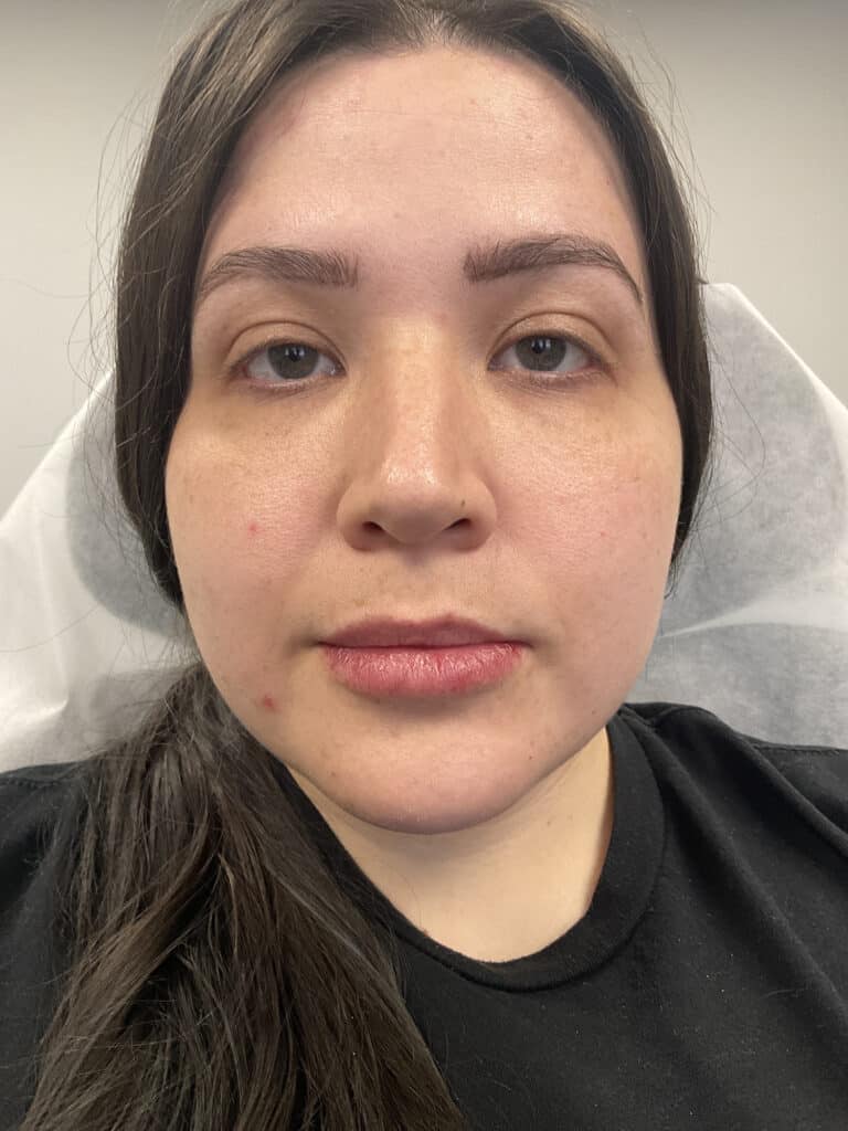 After Image: Lip Filler - front