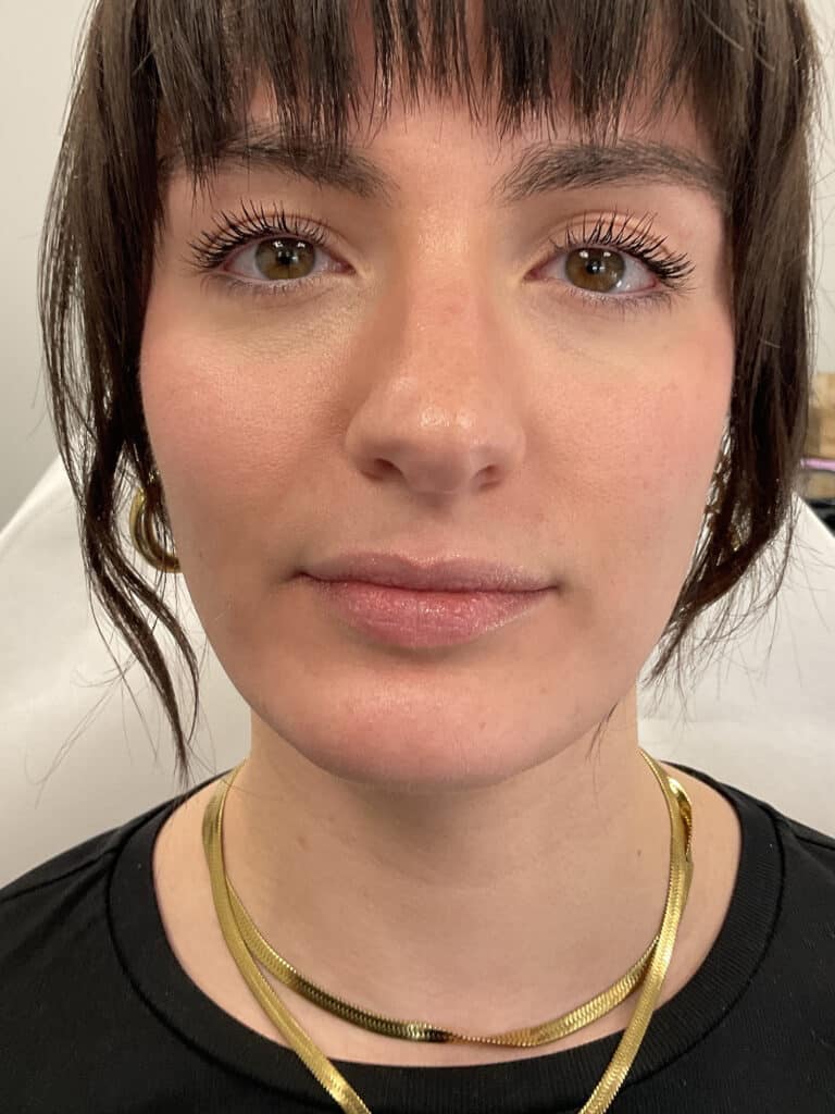 Before Image: Lip Filler - 