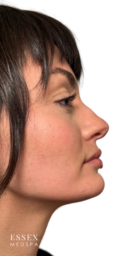 After Image: Lip Filler - right-side