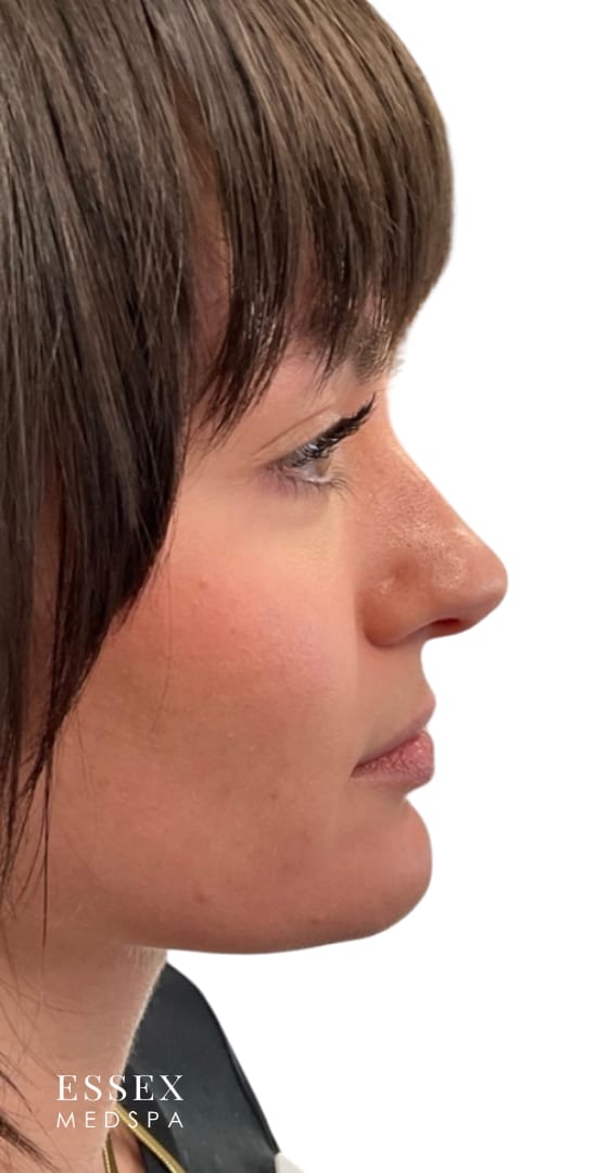 Before Image: Lip Filler - right-side