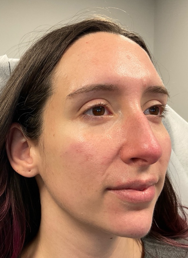 After Image: Dermal Filler for Facial Balancing - right-front-oblique