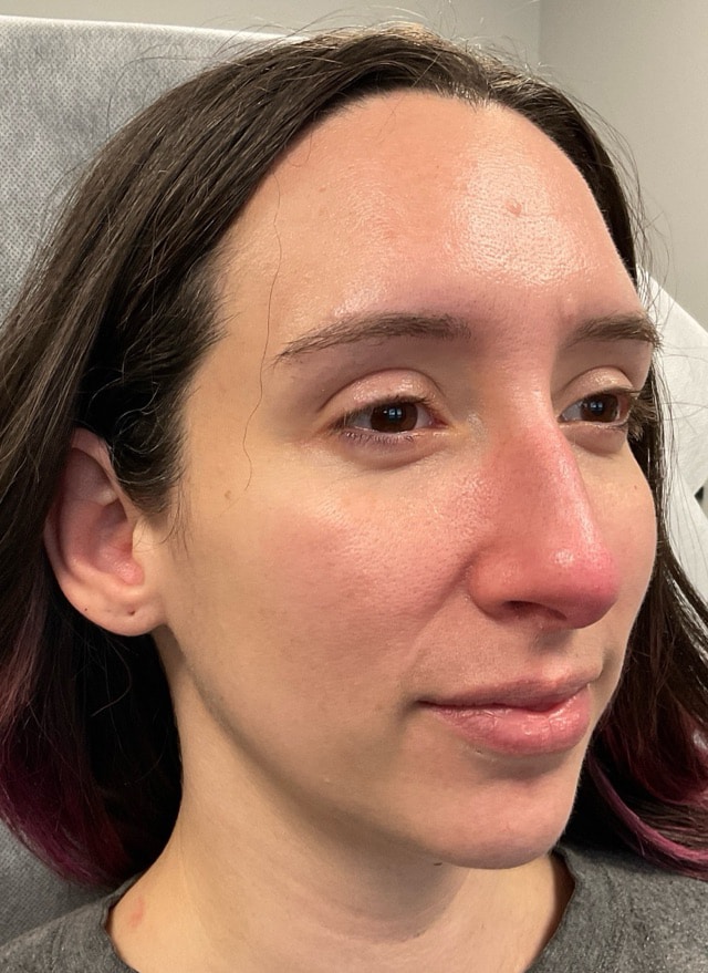 Before Image: Dermal Filler for Facial Balancing - right-front-oblique